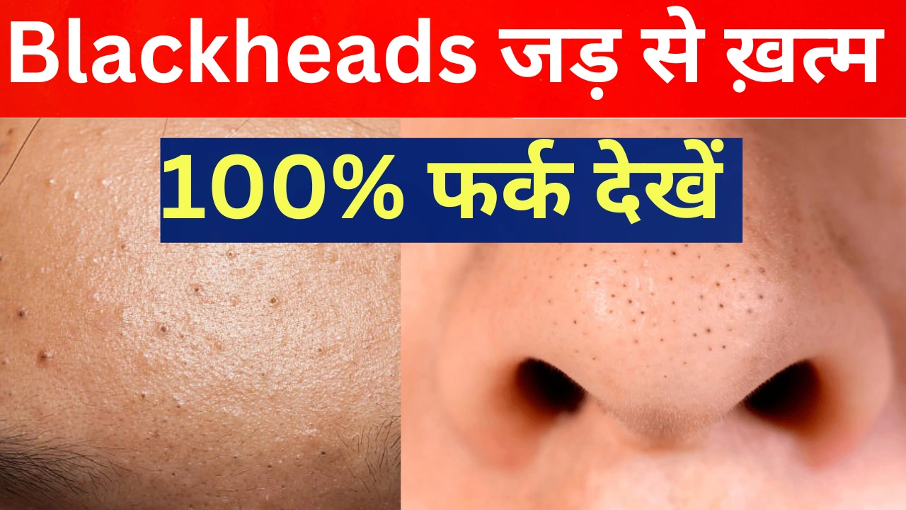 Tips to reduce blackheads